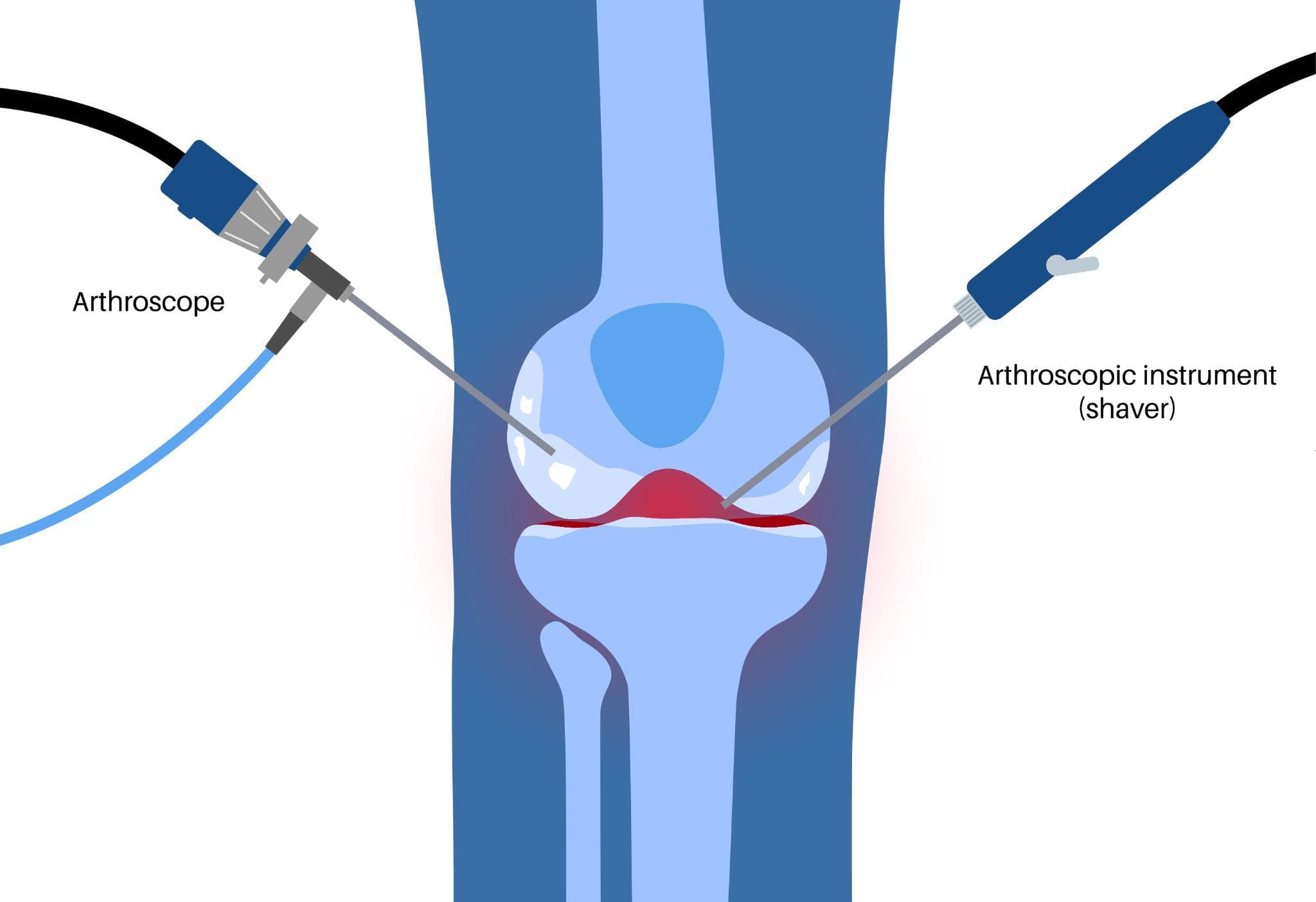 What Is Knee Arthroscopy and Do You Actually Need It? | Dr. Akash Dubey, Greater Noida