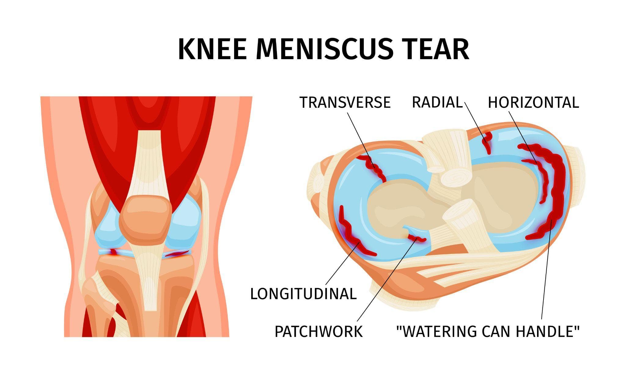 Meniscus Tear Treatment in Noida: Surgery vs. Non-Surgical Options | Dr. Akash Dubey