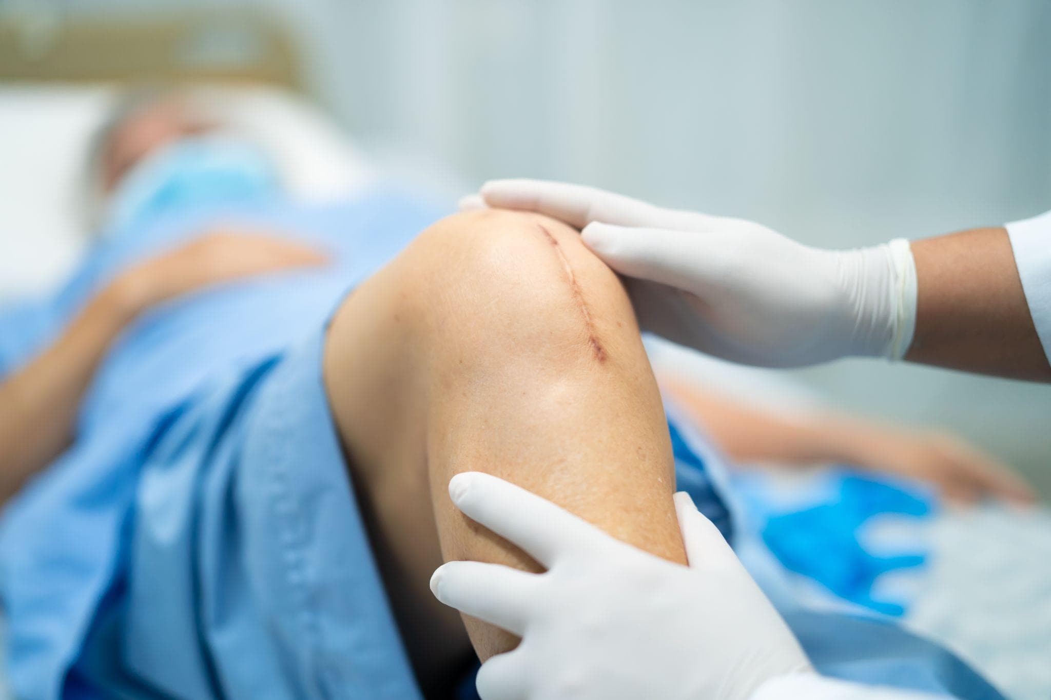 A healthcare professional examining a knee after total knee replacement surgery during recovery.